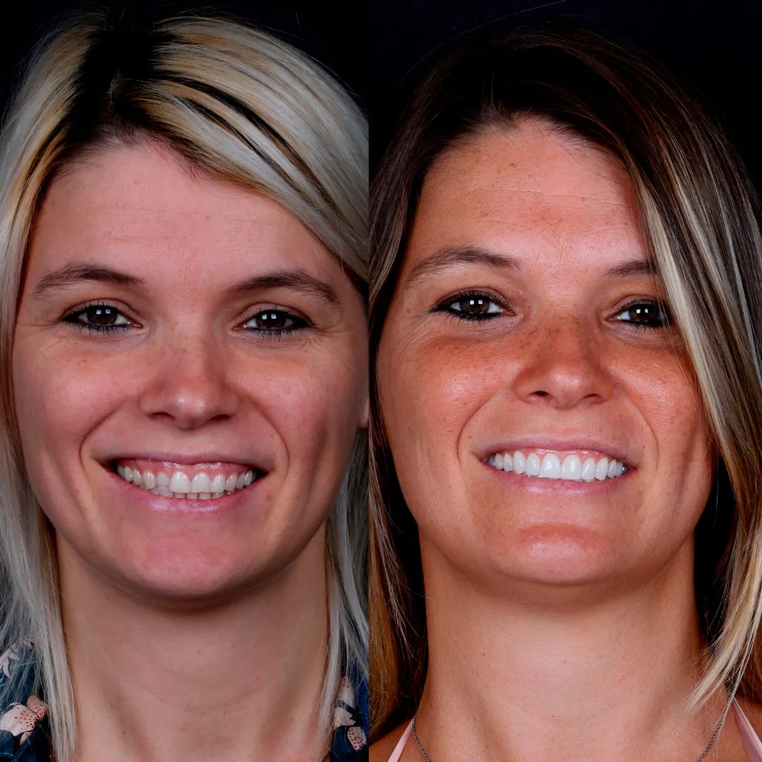 Dois retratos lado a lado de uma mulher a sorrir, com os dentes visíveis.