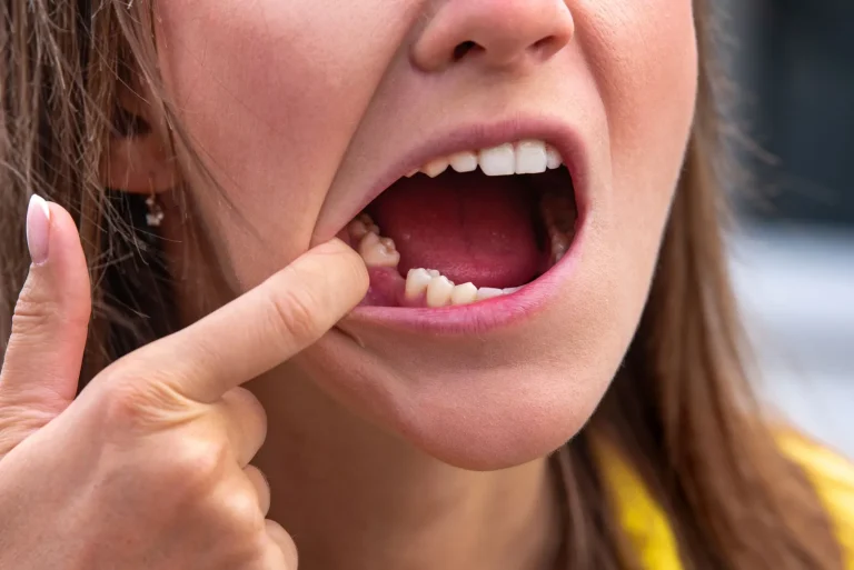 Mulher de boca aberta a apontar com o dedo para os dentes posteriores.
