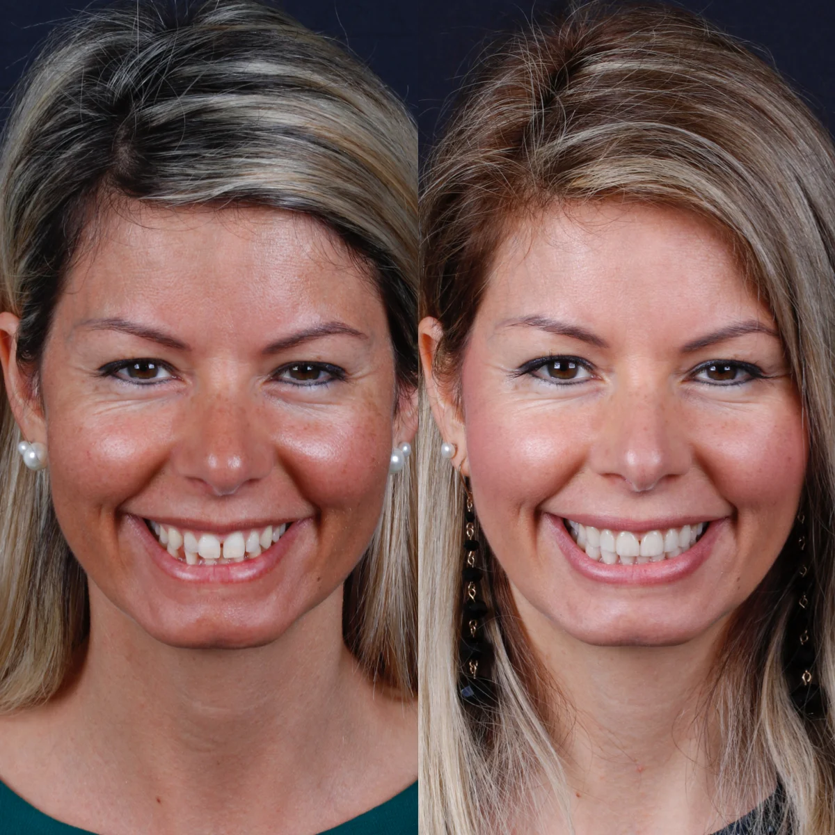 case-11-before-after