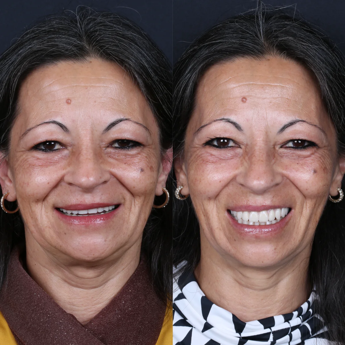 case-13-before-after