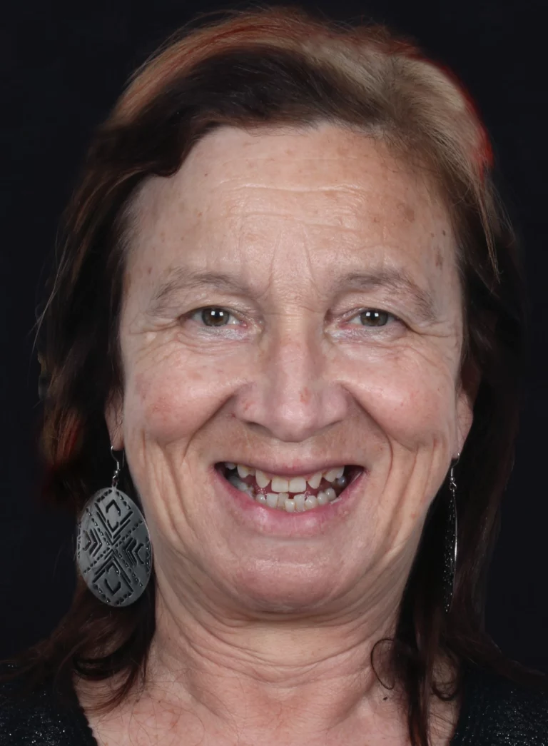 Retrato frontal de mulher a sorrir, com vários espaços visíveis na dentição.