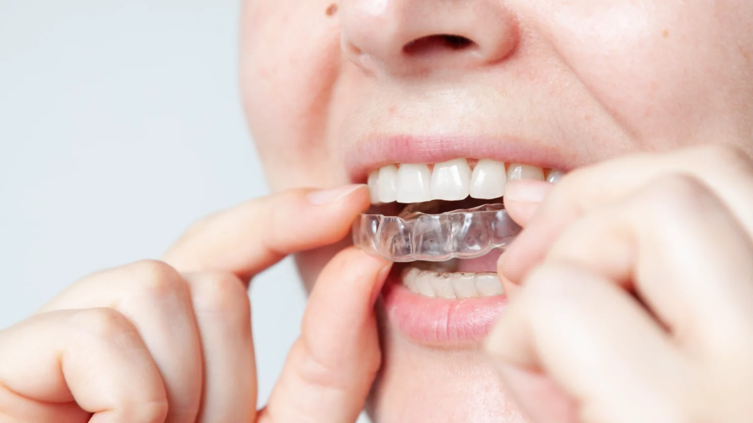Pessoa a colocar um aparelho de contenção transparente nos dentes superiores.