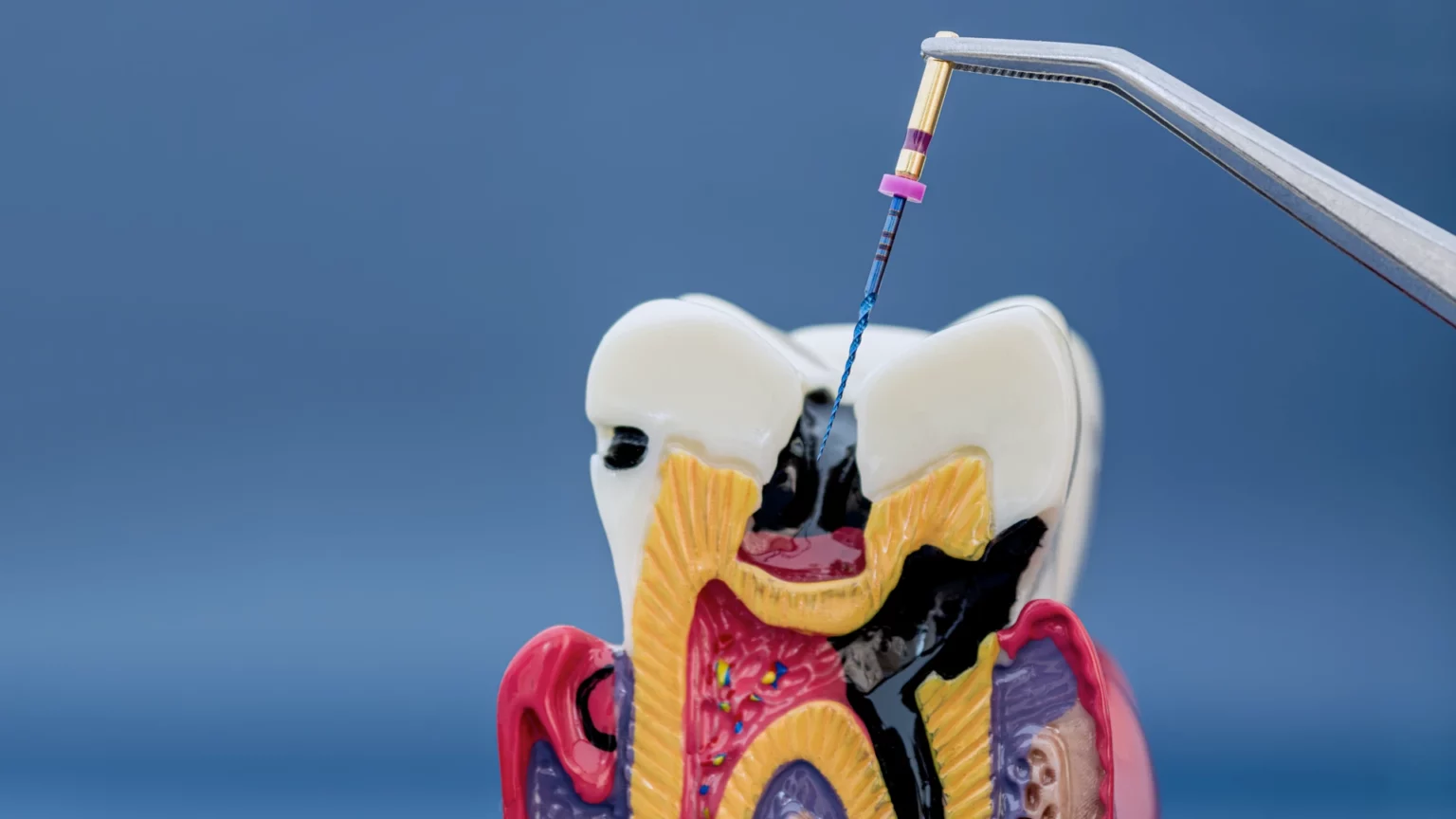 Modelo de um dente em corte com um instrumento fino no seu interior.