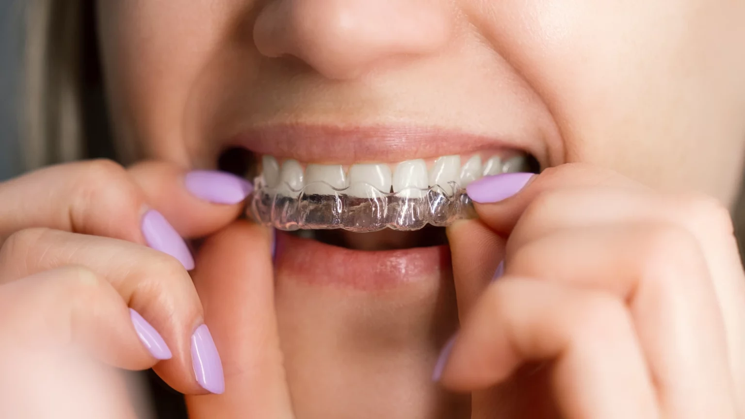 Mulher a colocar um alinhador transparente nos dentes superiores.
