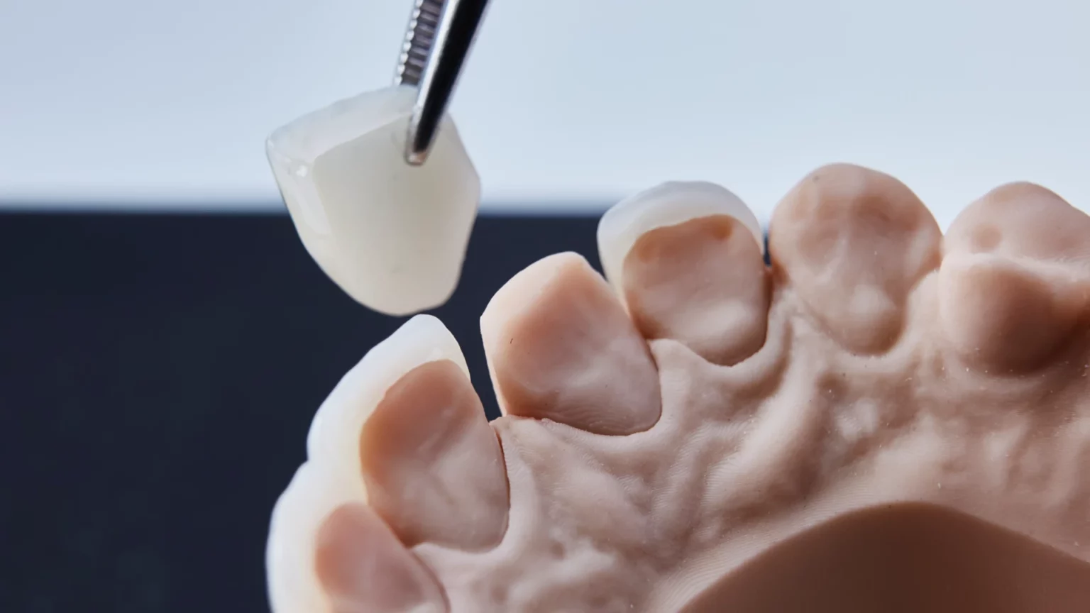 Faceta dentária segurada por uma pinça sobre um modelo de gesso da arcada superior.