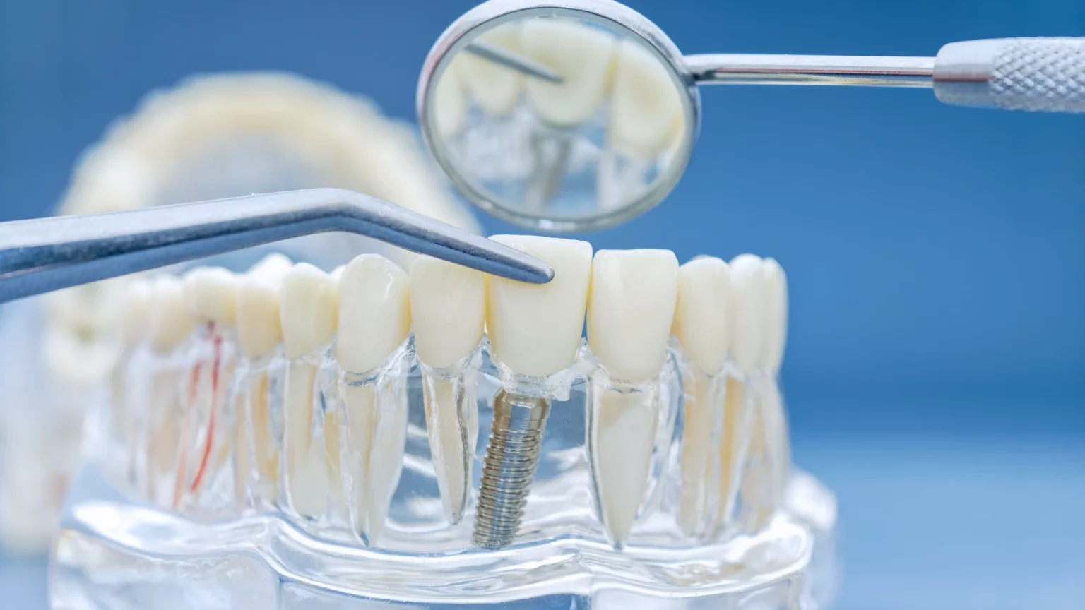 Modelo de uma arcada dentária com um implante visível e instrumentos de observação.