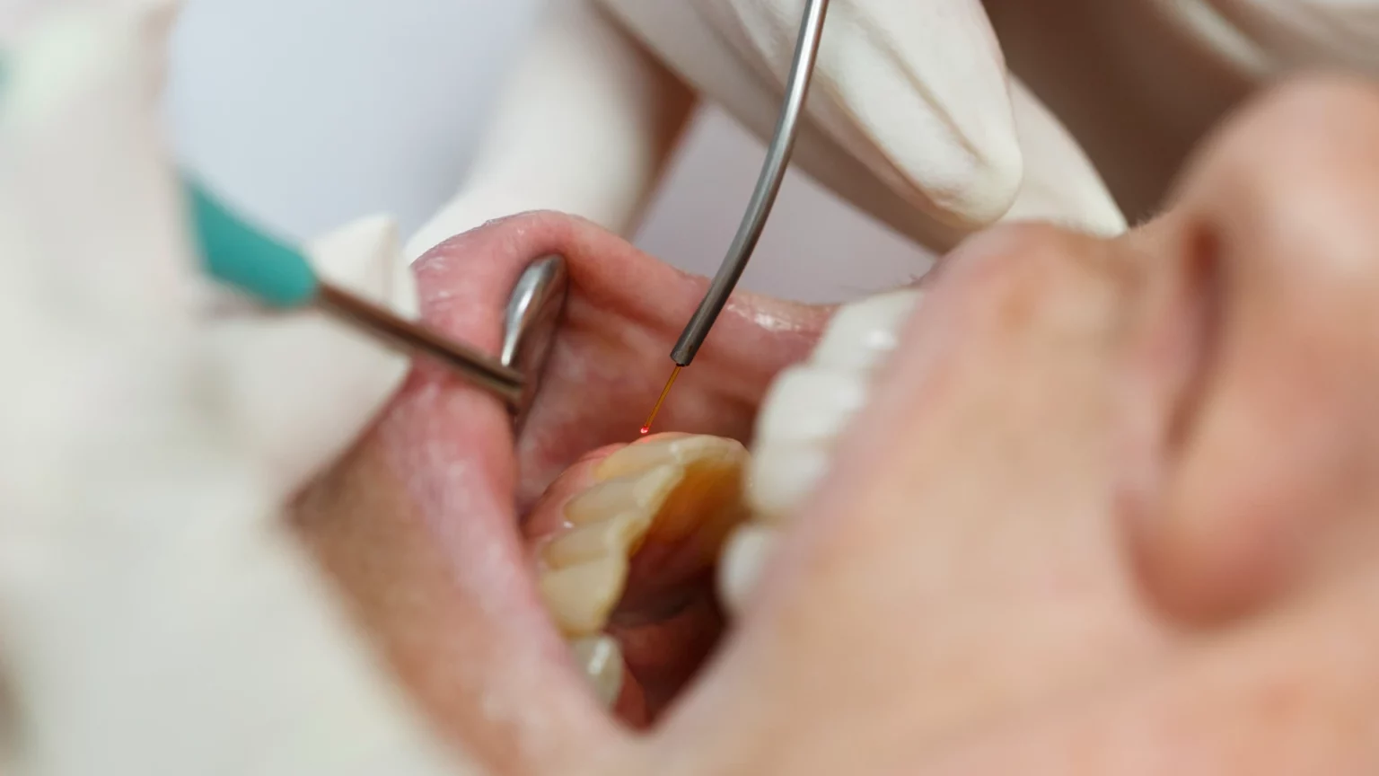 Aplicação de uma ponta fina junto aos dentes e à gengiva, com apoio de um espelho dentário.